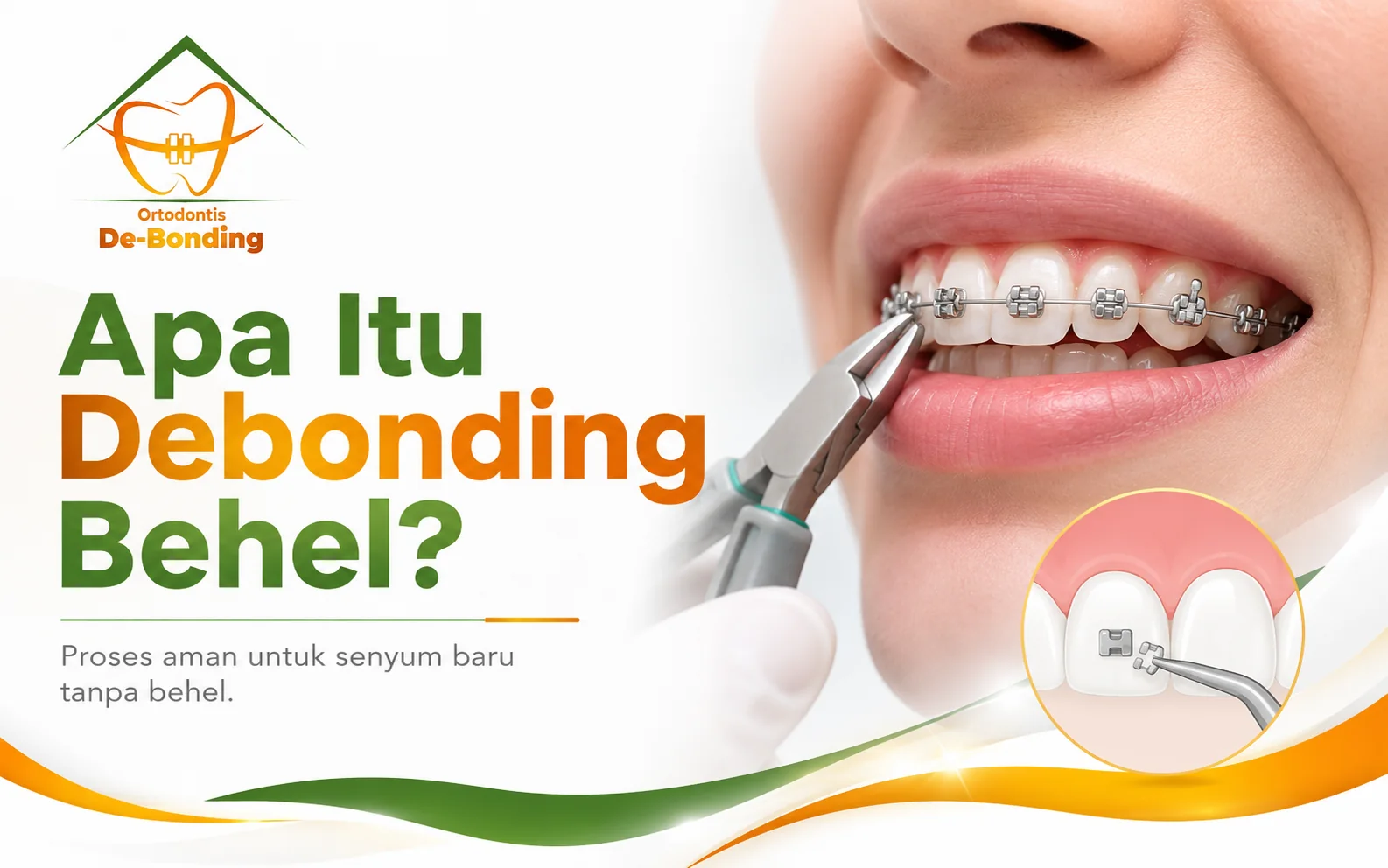 Apa Itu Debonding Behel?
